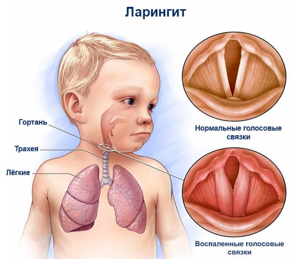 ОРВИ у ребенка: как не надо лечить