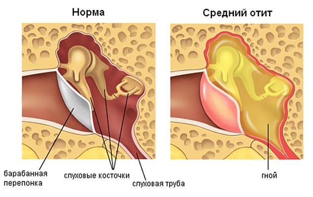 ОРВИ у ребенка: как не надо лечить